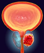 Example of the prostate organ and the cancerous growth