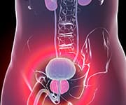 Prostate within the body having focal therapy for prostate cancer