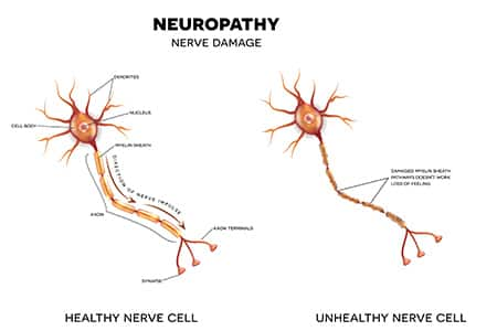 Diagram of a health nerve cell and an unhealthy one through neuropathy damage