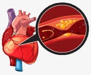 Example of atherosclerosis in blood vessel and heart