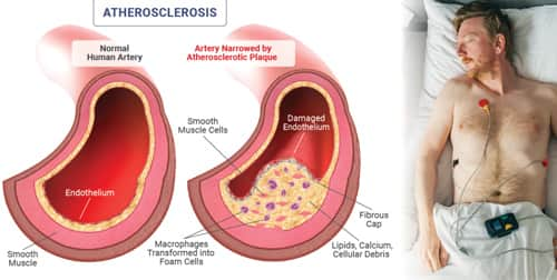 Diagram of a healthy artery versus one with atherosclerotic plaque