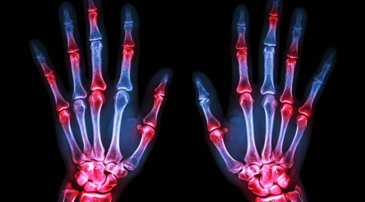 Arthritis - Rheumatoid